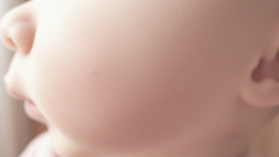 Jakie są przyczyny trądziku niemowlęcego?
